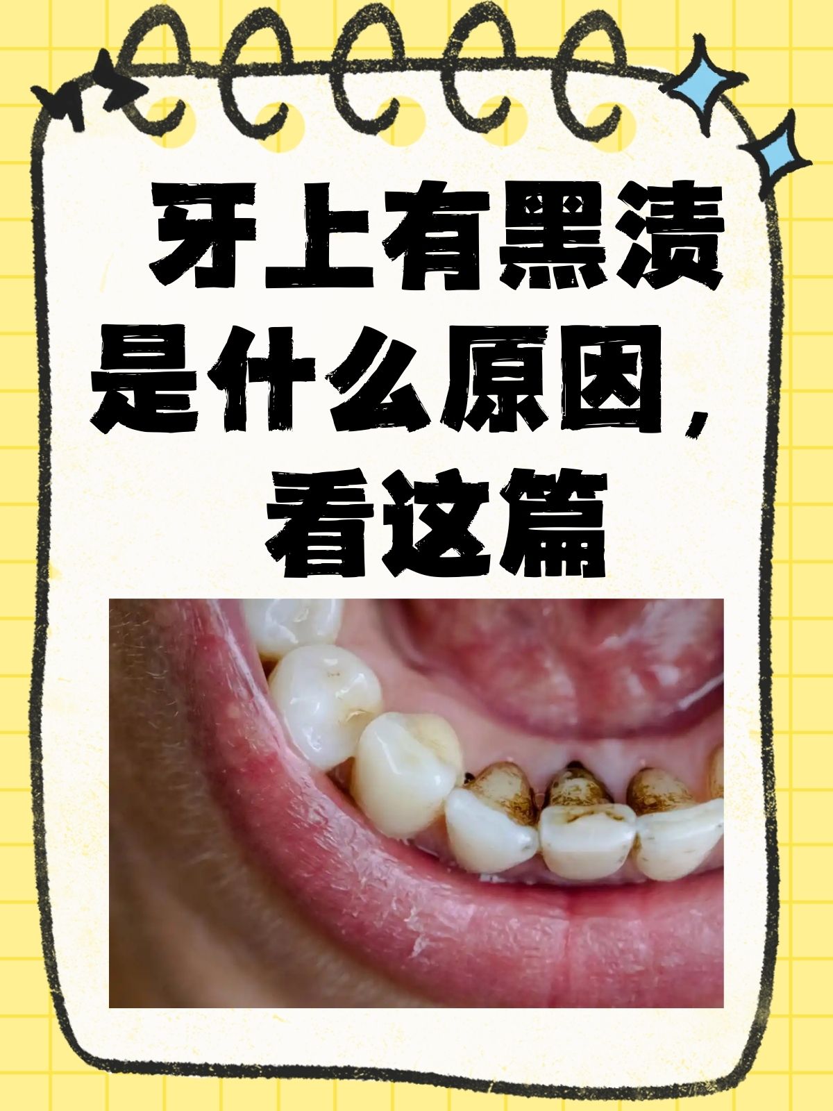 看这篇 在日常生活中,有时候可能会注意到牙齿上不经意间出现的黑渍