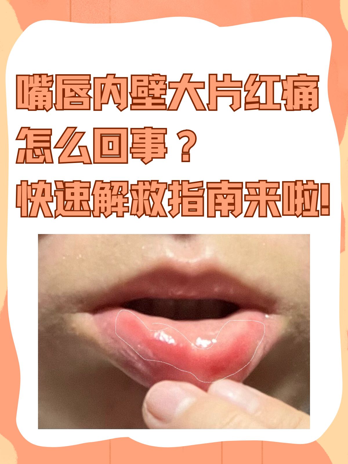 嘴唇内壁大片红痛怎么回事?快速解救指南来啦!