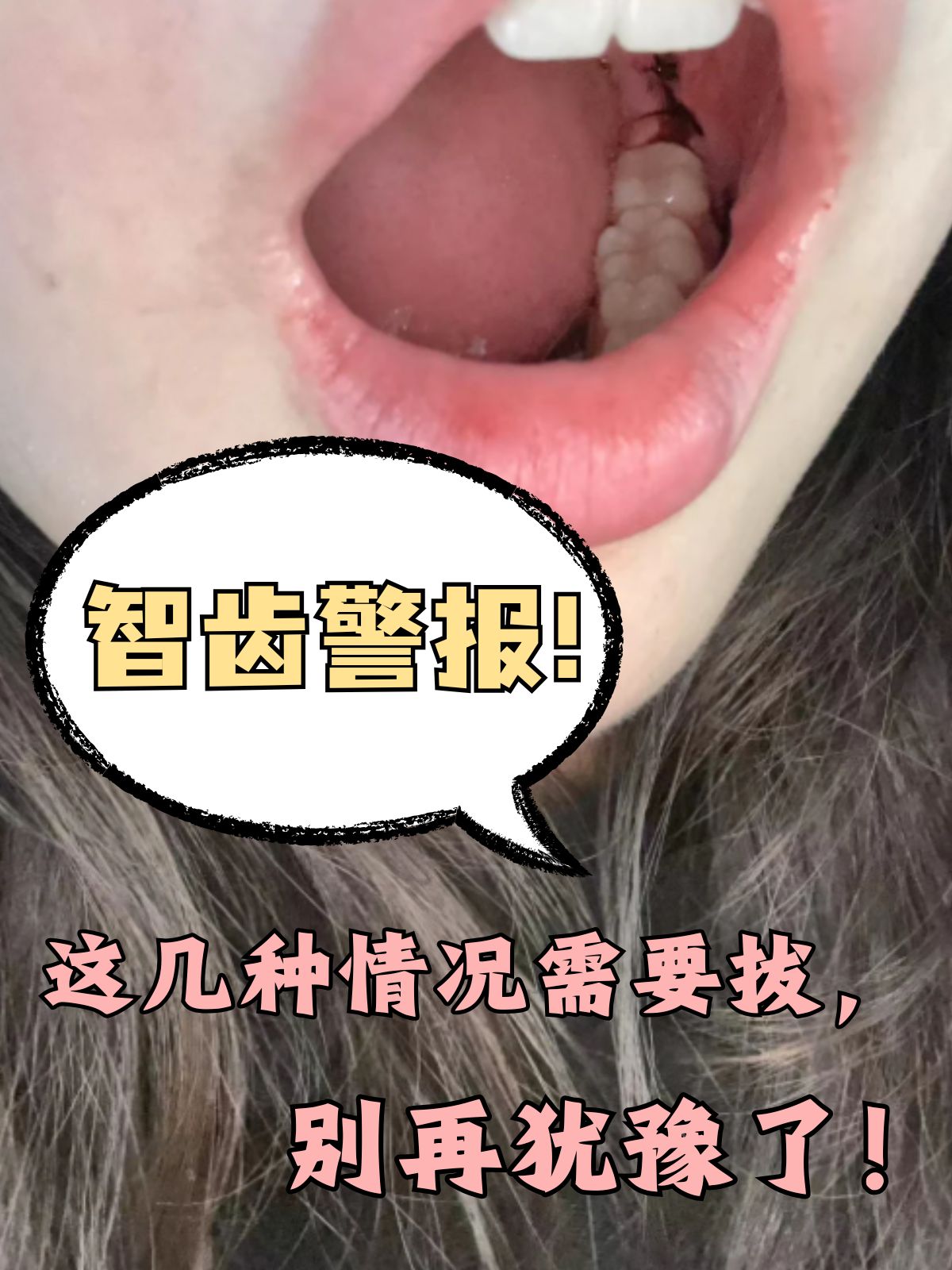 为什么智齿会发炎 为什么智齿会发炎