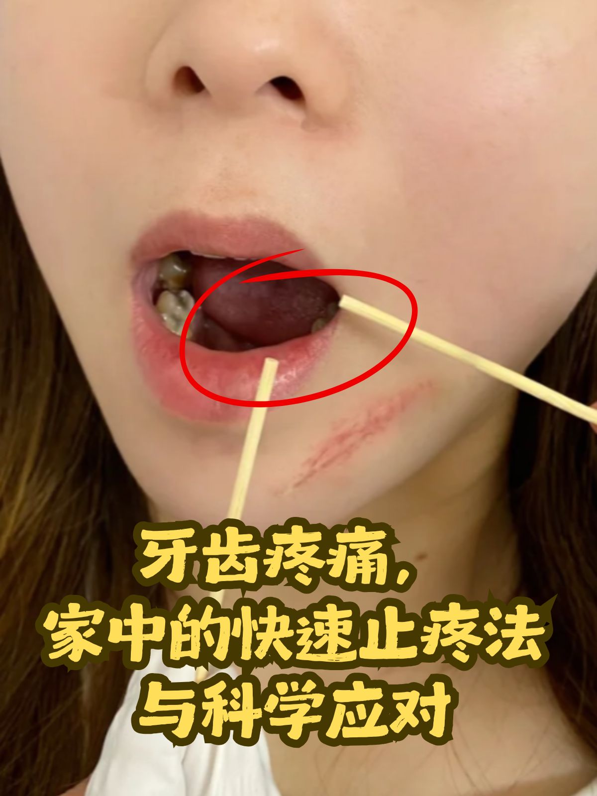 牙齿疼痛,家中的快速止疼法与科学应对 牙疼可能由多种因素引起,包括