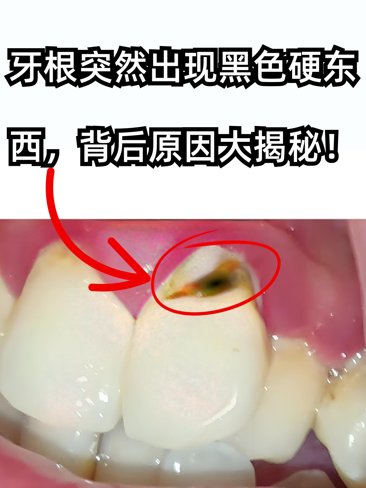 牙根突然出现黑色硬东西,背后原因大揭秘!