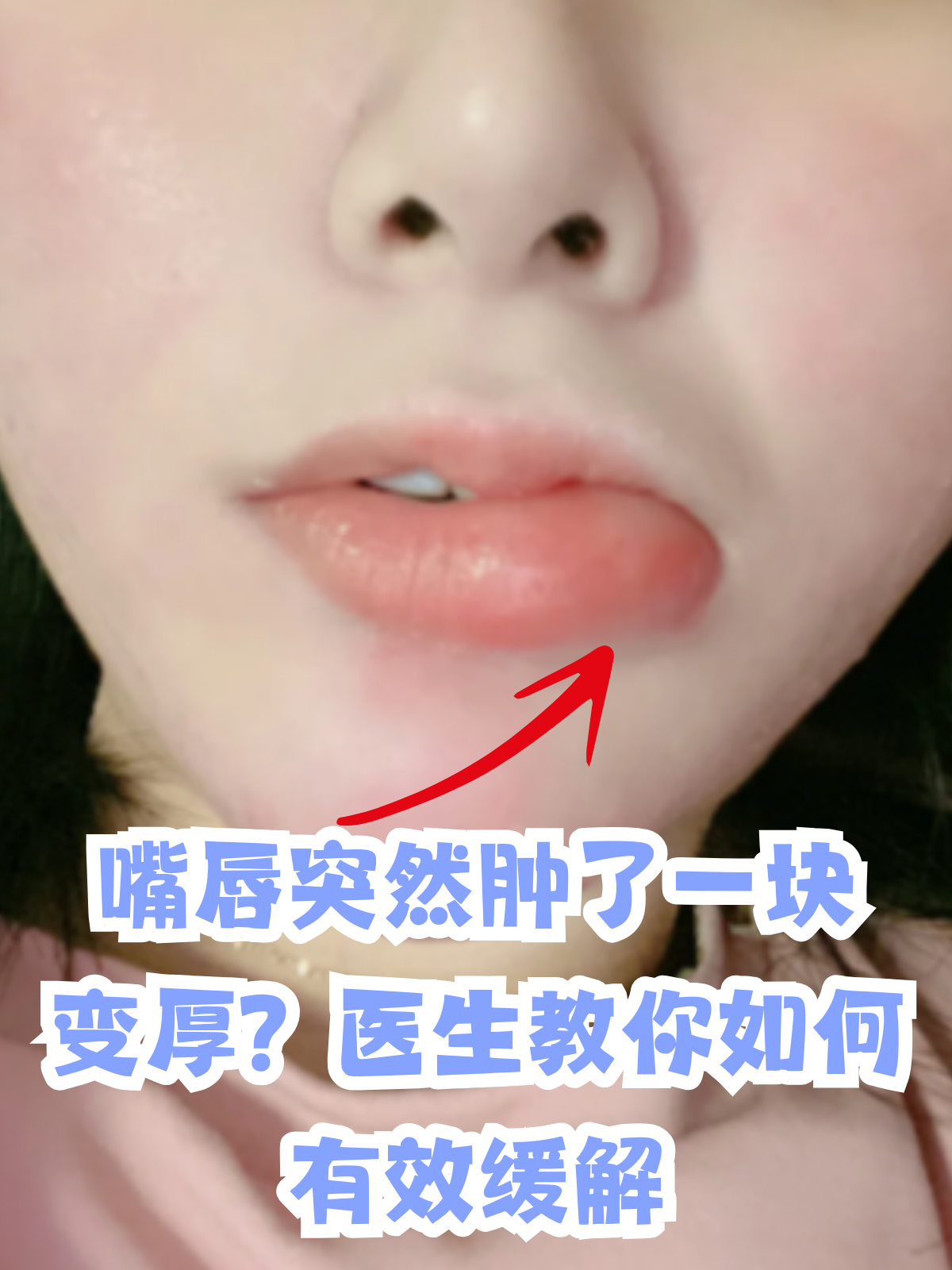 嘴唇为什么会肿