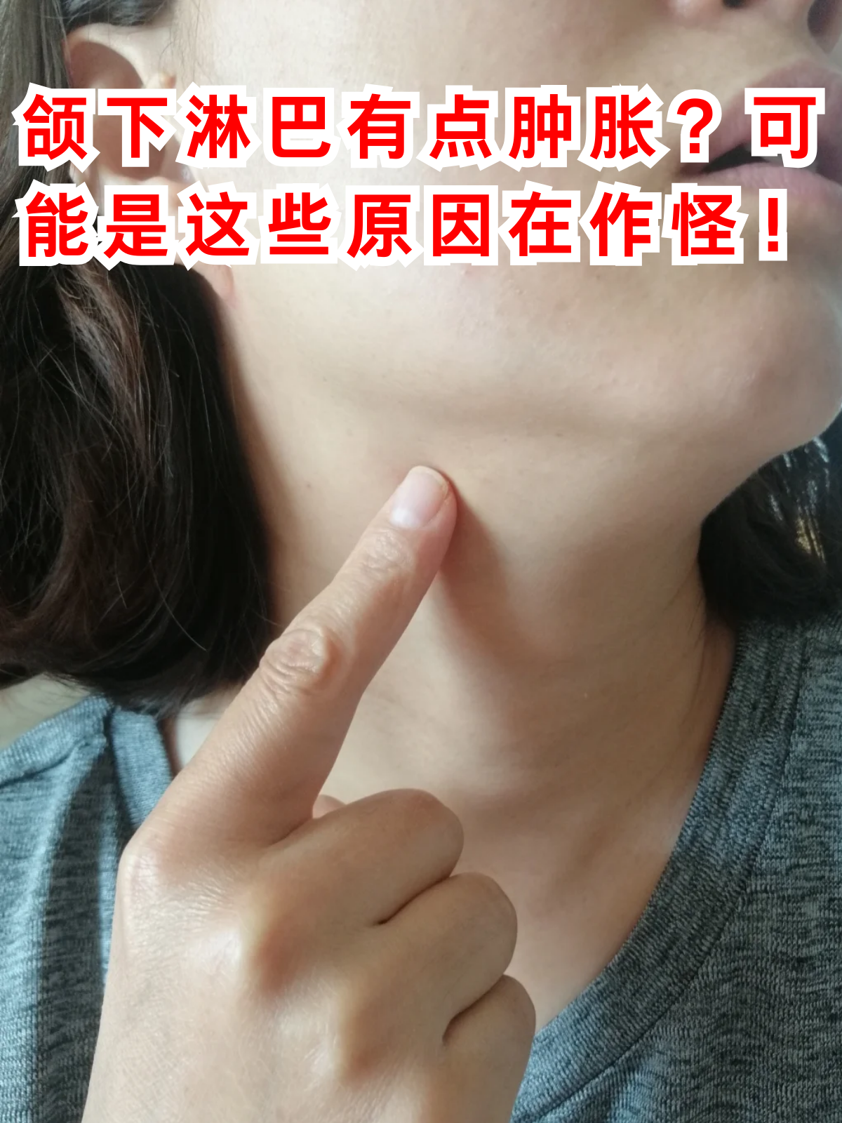 常见的如下所示: 牙龈炎:牙龈炎通常由牙菌颌下淋巴结肿大图片颌下