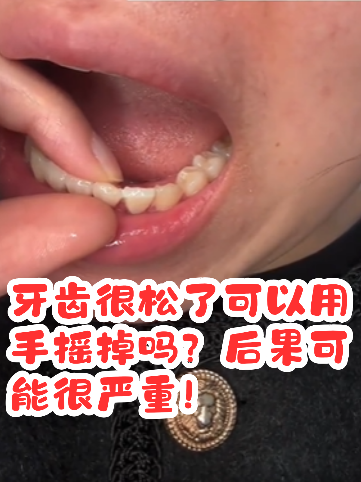 面对松动的牙齿, 牙齿松动牙齿三度松动的照片牙齿松动的图片牙齿松动