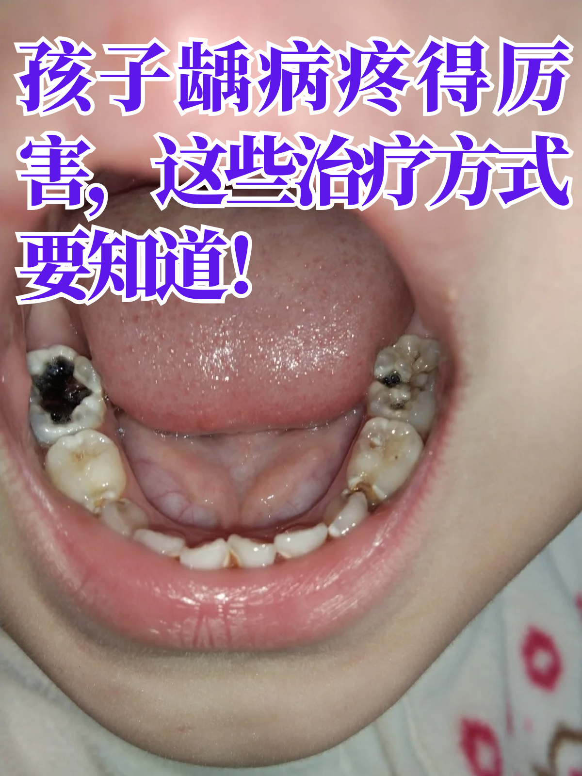 孩子龋病疼得厉害,这些治疗方式要知道!