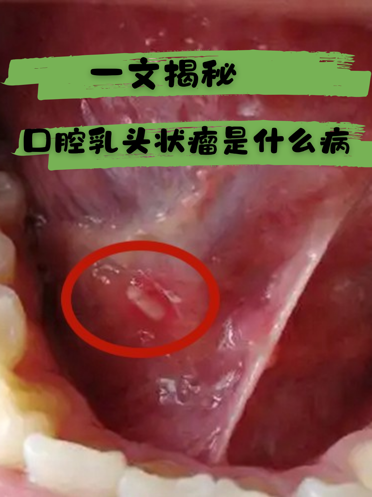 一文揭秘:口腔乳头状瘤是什么病 口腔乳头状瘤是一个在口腔中可能出现
