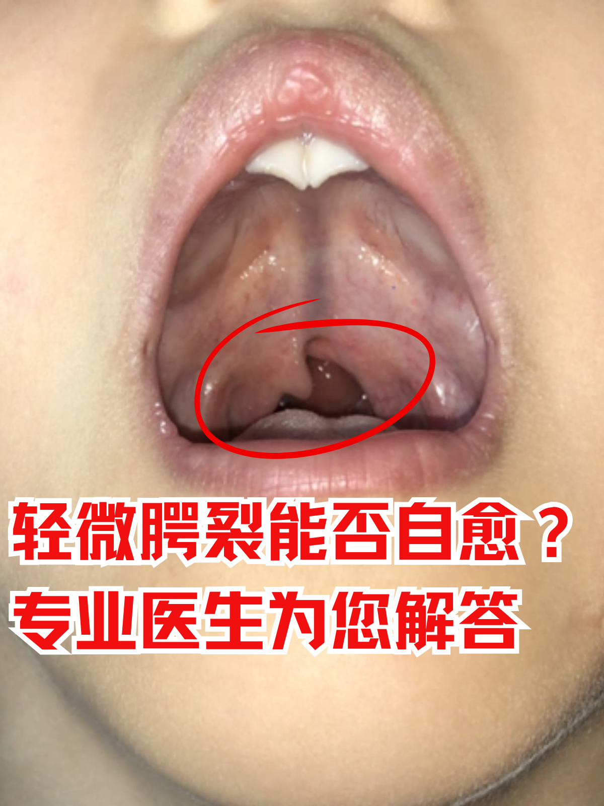腭裂是由于胚胎发育障碍引起的疾病,表现为腭部的腭突未能正常融合