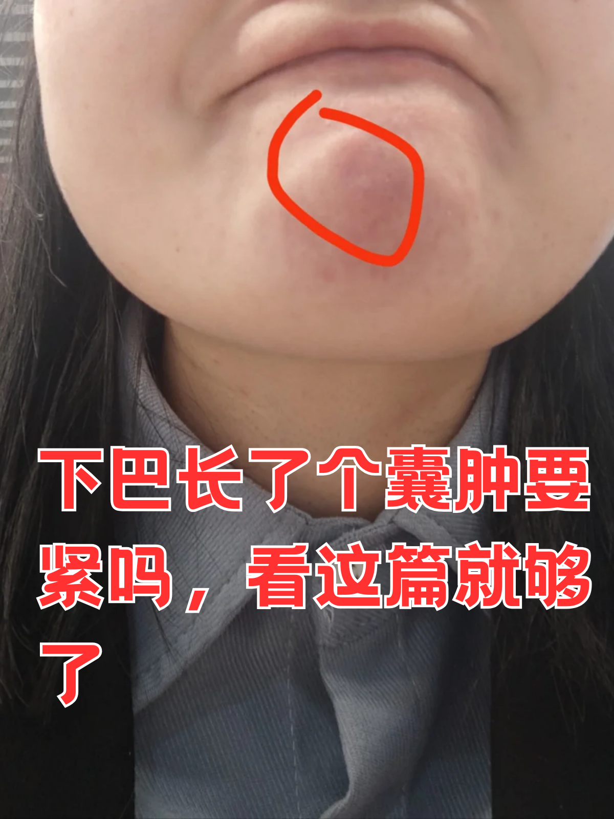 那么,下巴长囊肿究竟要紧吗?