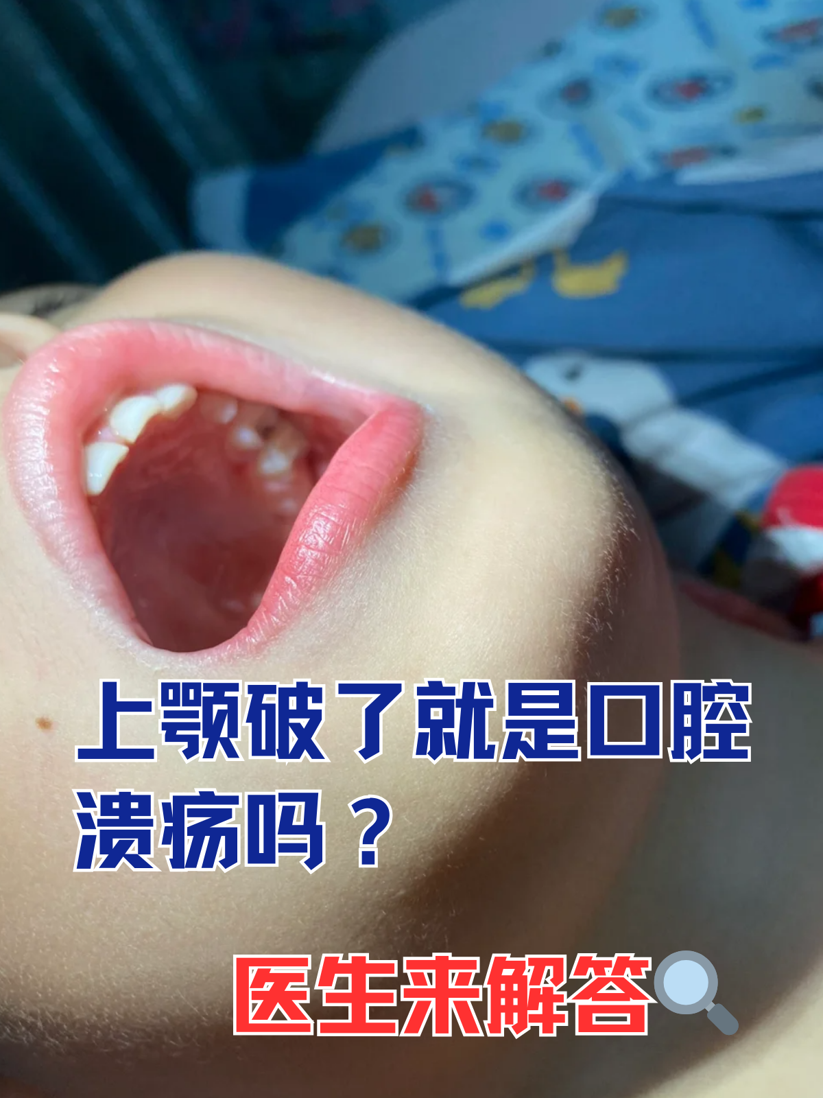 医生来解答 口腔溃疡通常表现为口腔内圆形或椭圆形的溃疡创面,伴有