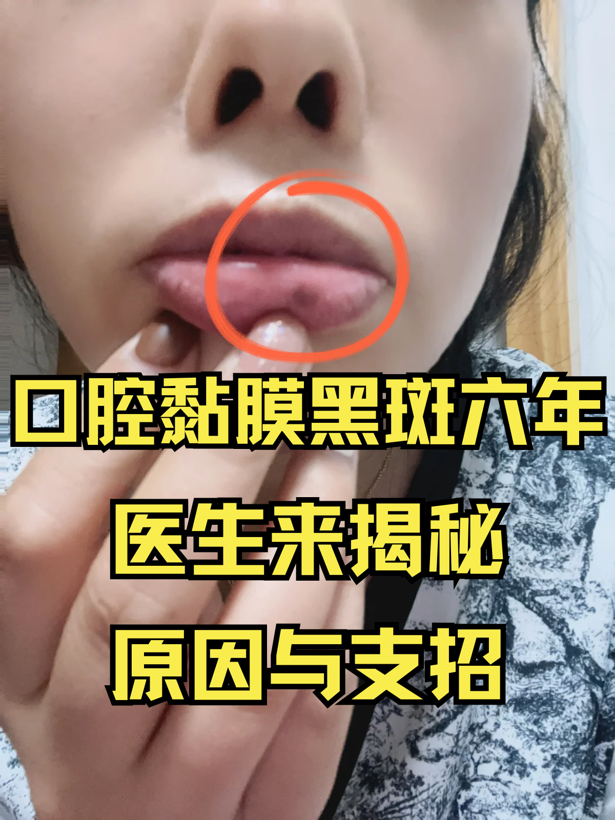 口腔黏膜黑斑六年,医生来揭秘与支招!