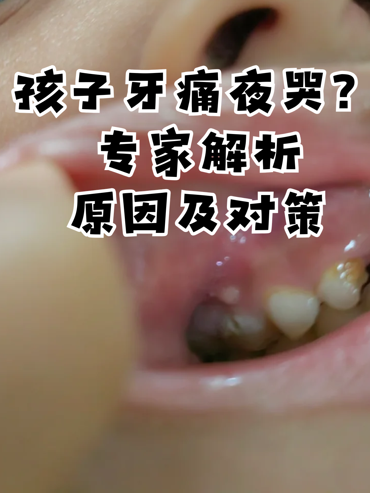 专家解析夜间牙痛原因及对策 孩子晚上因为牙齿疼痛而难以入睡的情况