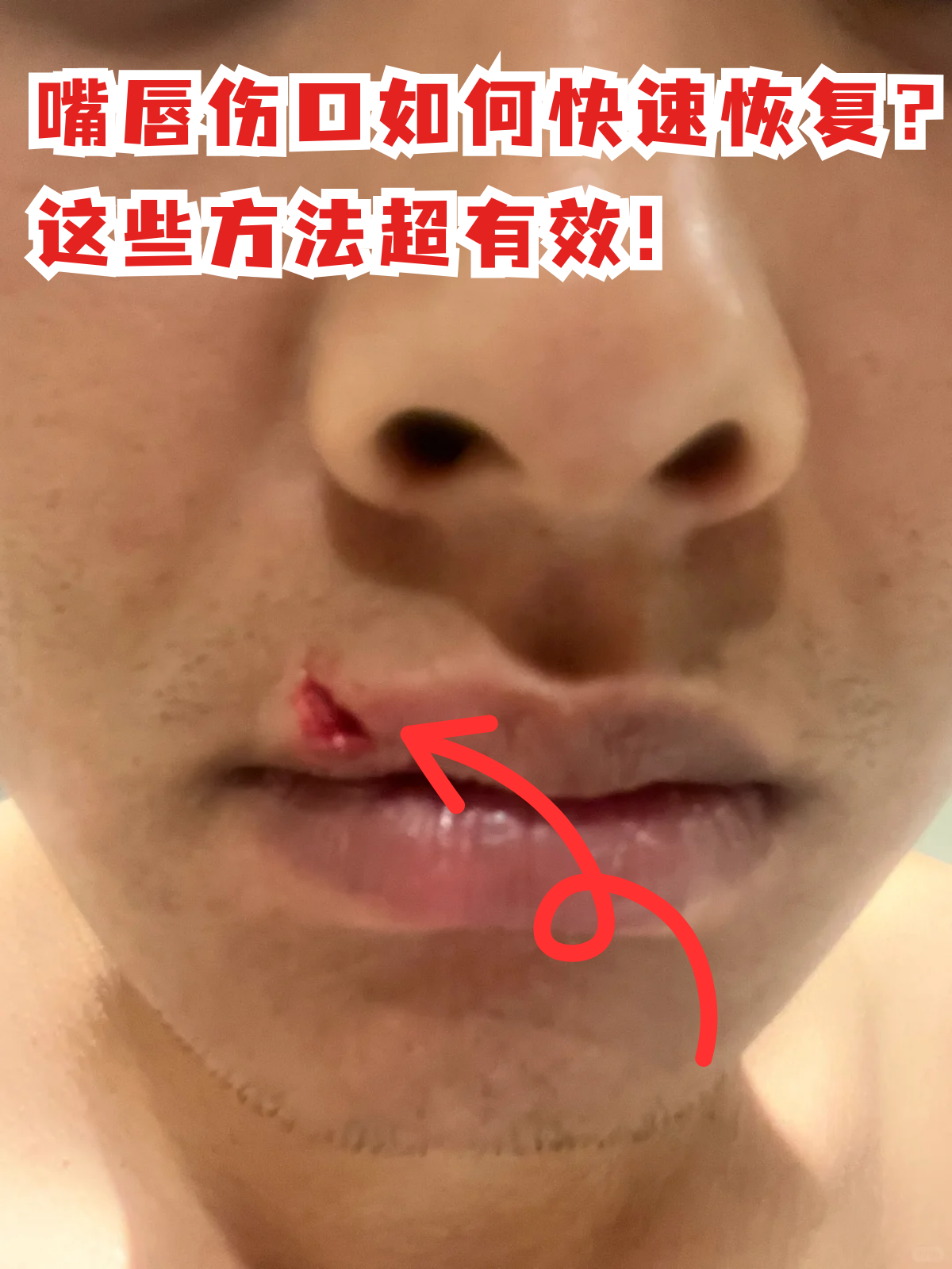 嘴唇缝针10天恢复图口唇全层裂创法医鉴定图片嘴唇缝针后疤痕图片摔跤