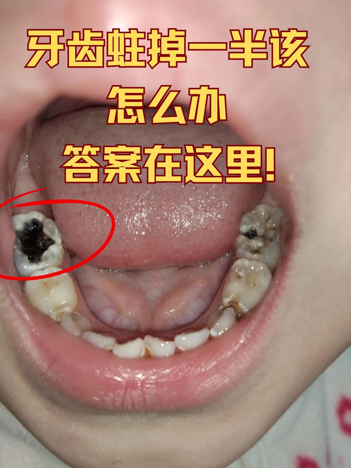 倍牙齿烂了个大窟窿怎么治牙齿蛀虫图片牙齿蛀虫牙齿蛀掉一半该怎么办