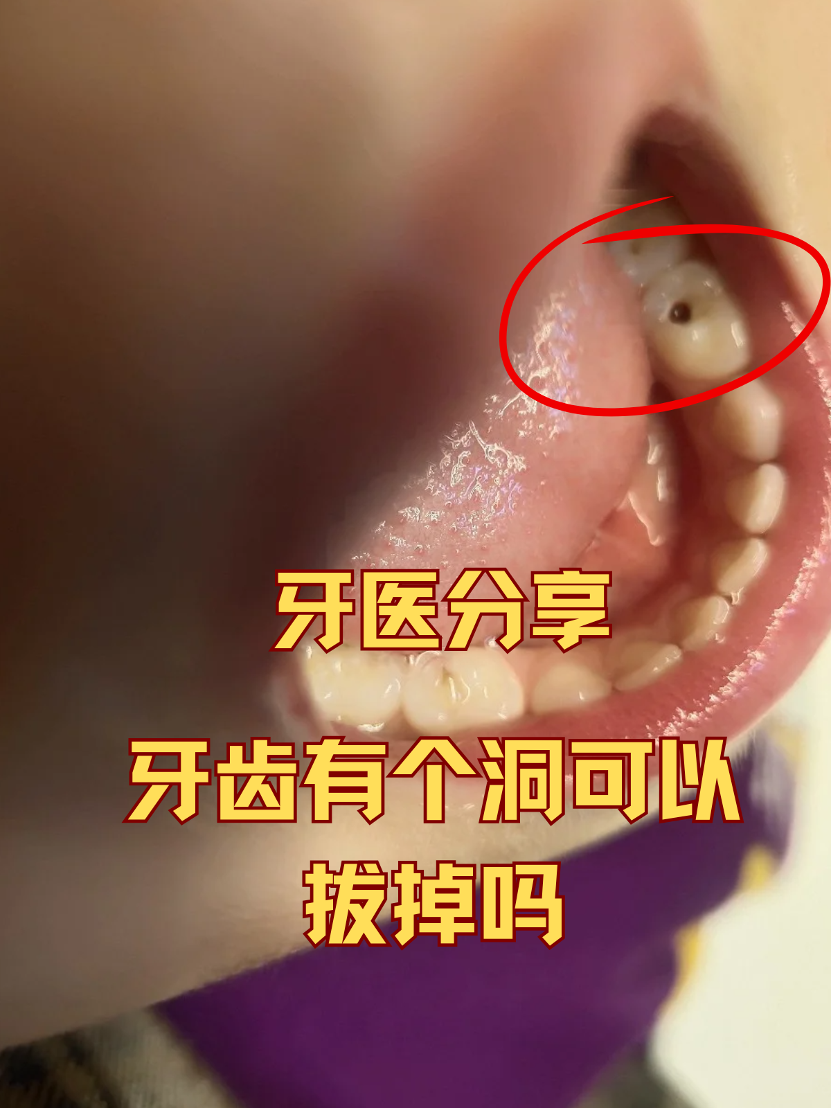 牙龈撑开一个洞牙洞图片牙齿有洞牙齿烂了一个洞很痛怎么办牙齿上有个