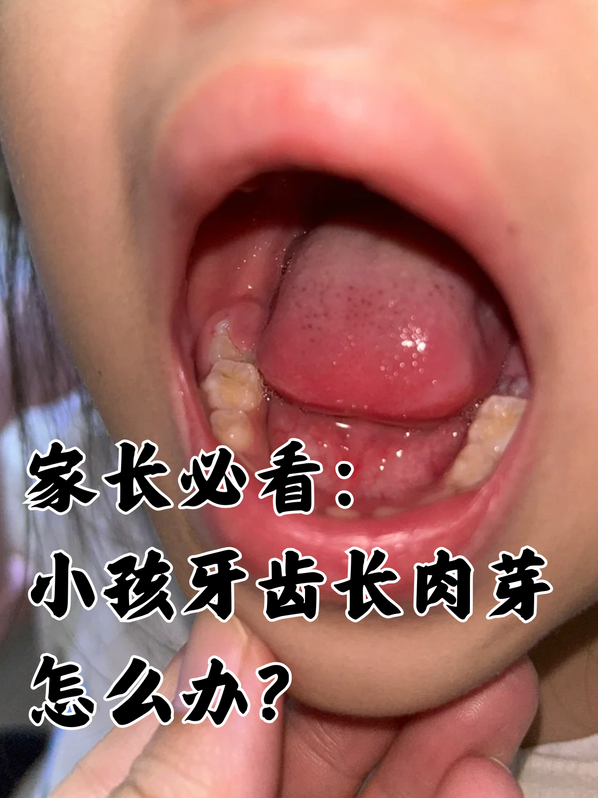 家长必看:小孩牙齿长肉芽怎么办?