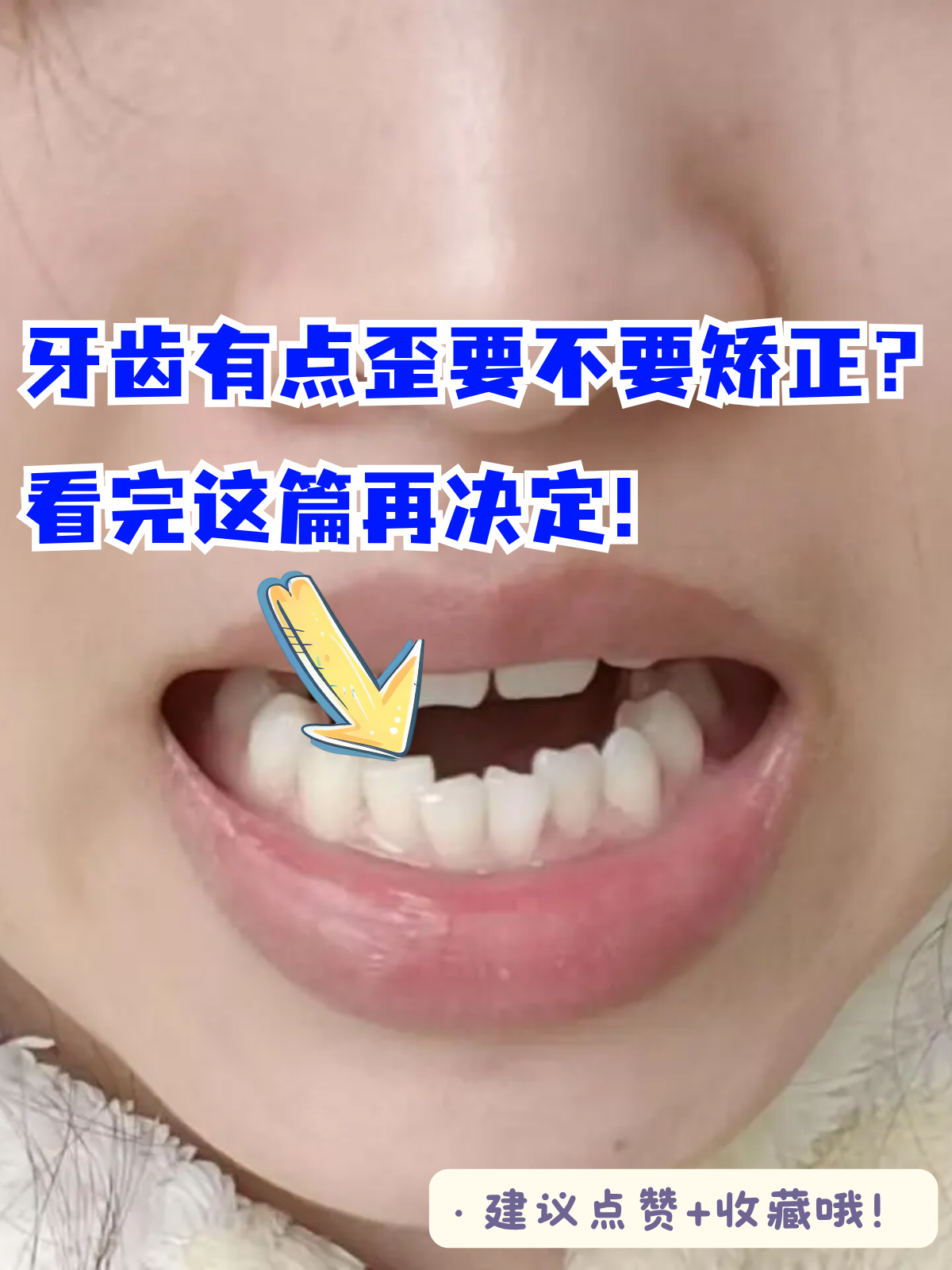 牙齿排列轻度不整齐是许多人面临的问题,不少人会纠结:"牙齿有点歪