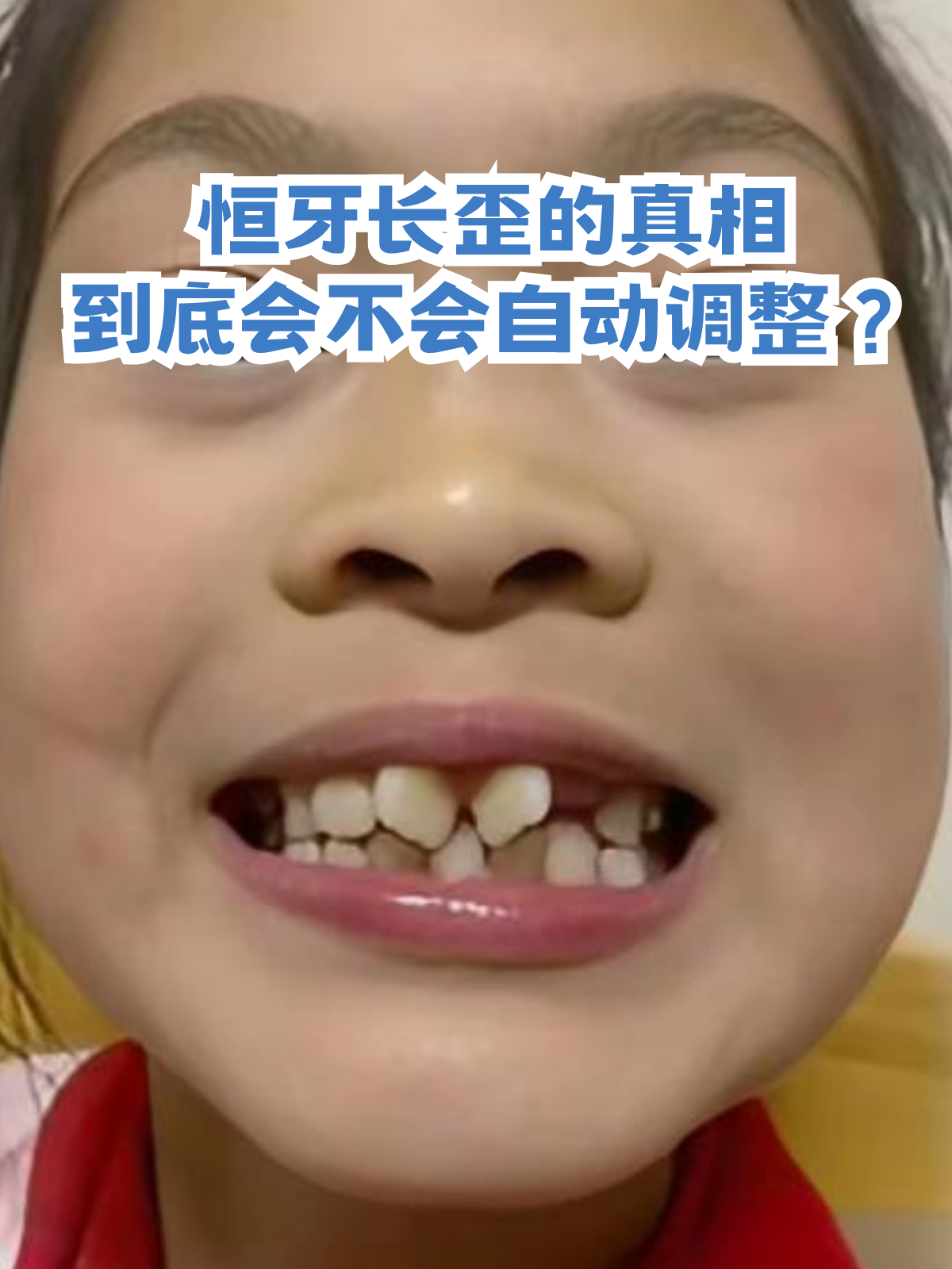 了怎么办牙齿长歪了小孩换牙齿门牙长歪了怎么办恒牙是在哪个位置图片