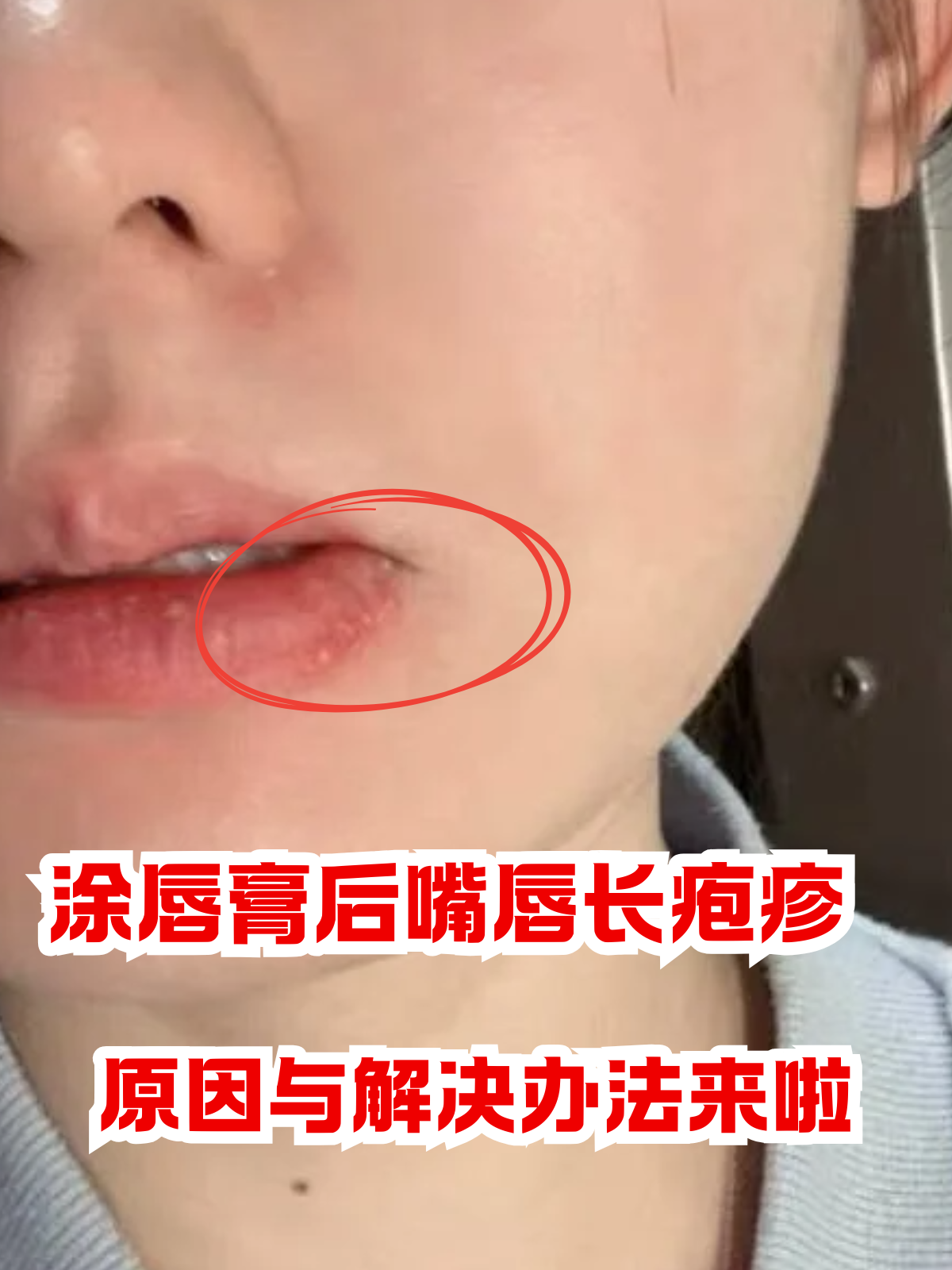 在涂唇膏后嘴唇长疱疹,通常口唇疱疹嘴唇疱疹10种嘴唇疱疹图片口唇