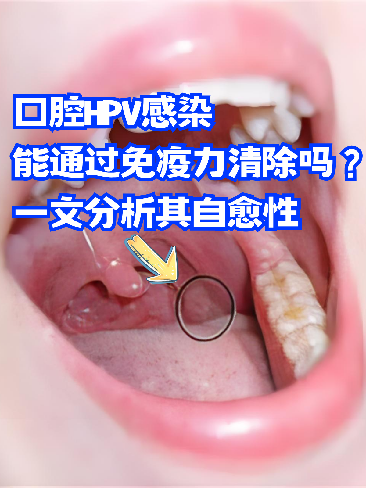 hpv即人乳头瘤病毒,不仅可能引起生殖系统的病变,也可能感染口腔黏膜