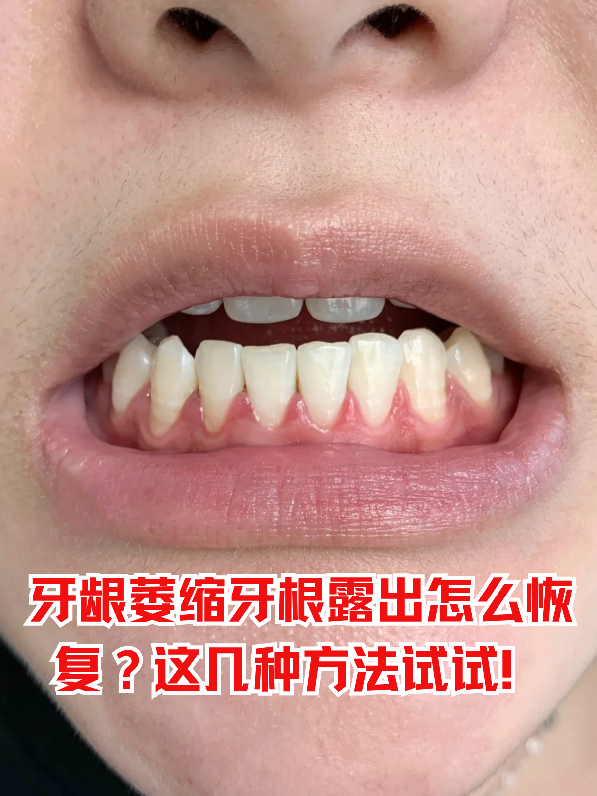 对着镜子刷牙时,突然发现牙齿变长,牙根隐隐发白,甚至吃冷热食物时