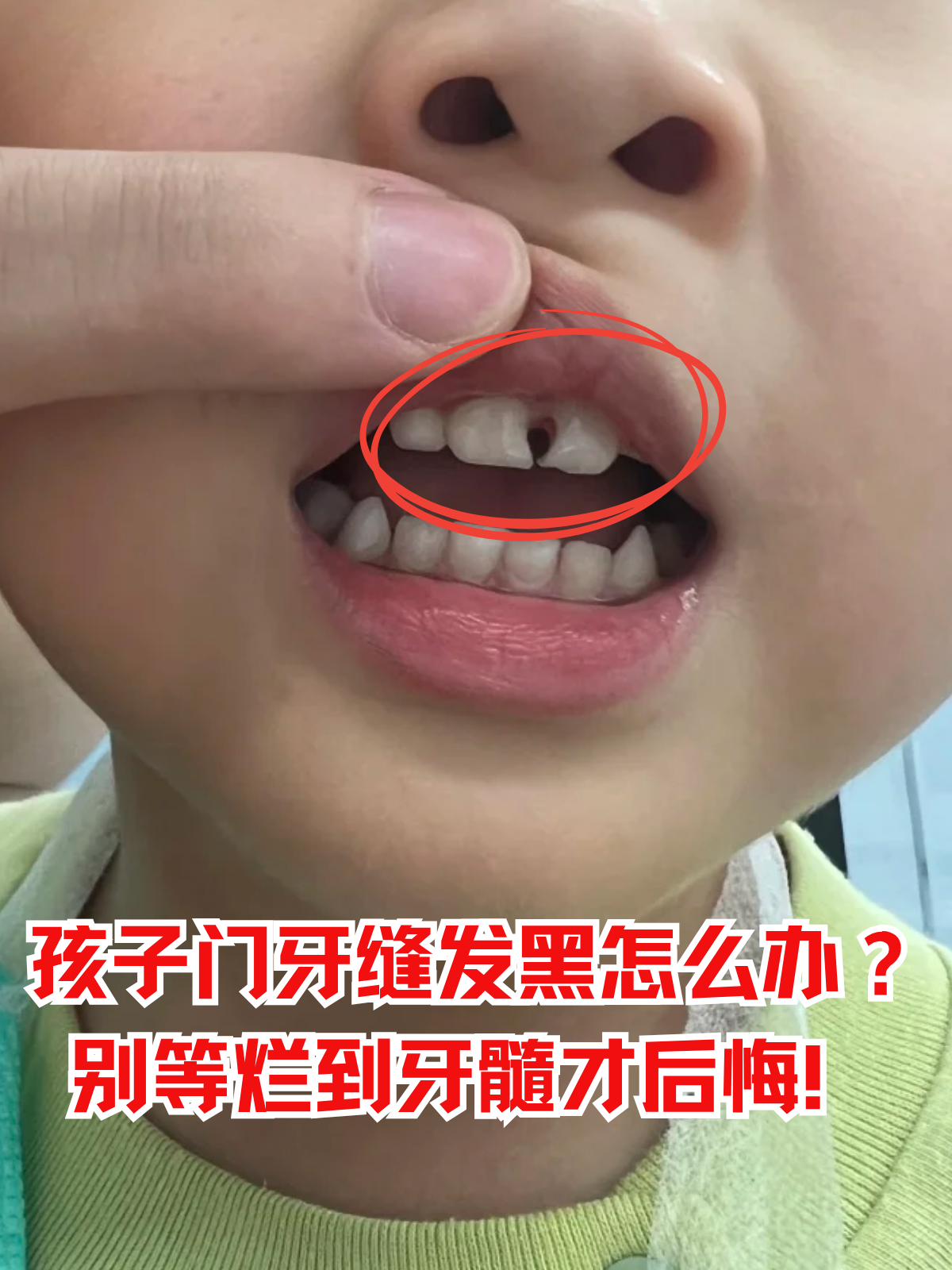 的孩子越来越多,而这看似不起眼的小黑缝,很可能是龋齿"偷袭"的信号