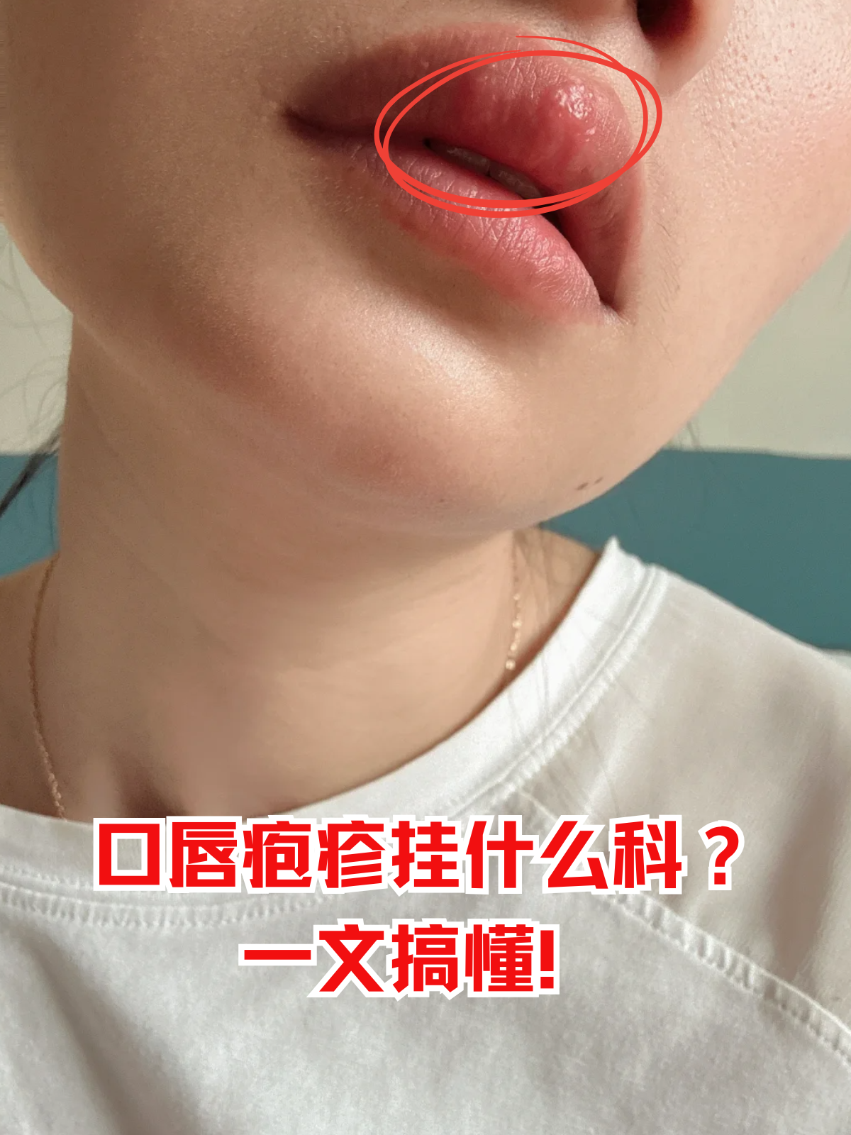 口唇疱疹挂什么科?一文搞懂!