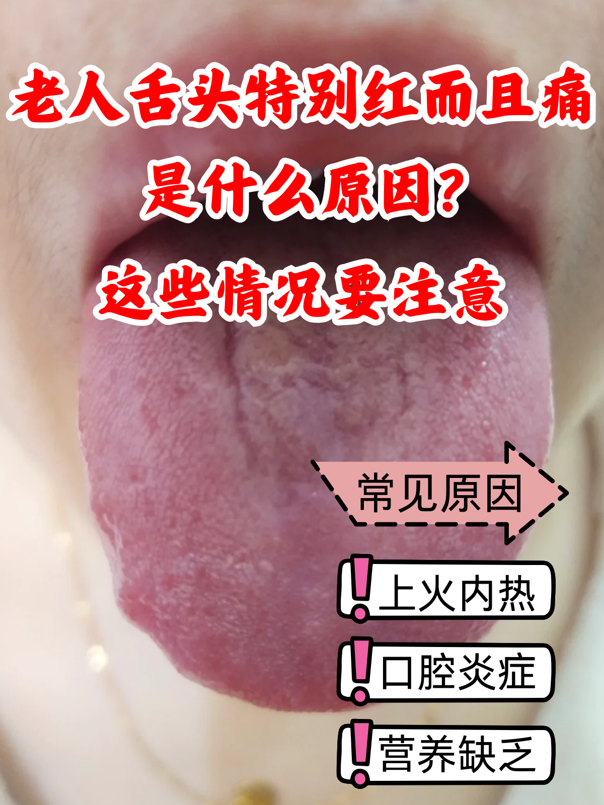 老人舌头特别红而且痛是什么原因?