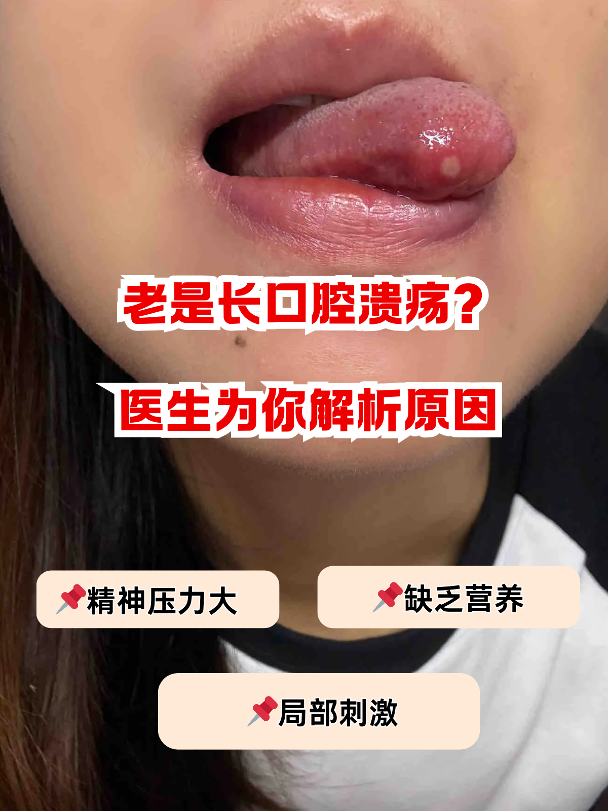 为什么总长口腔溃疡