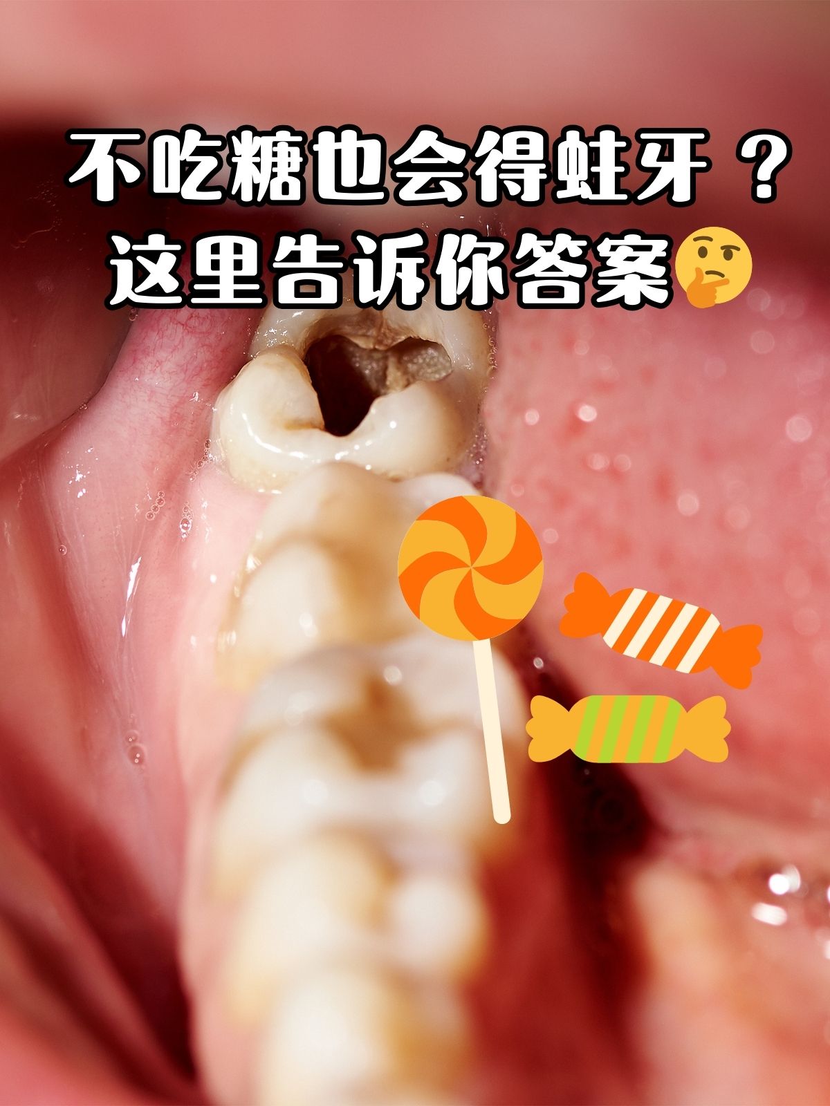 这四个因素相互作用,共同导致了龋齿的发生.