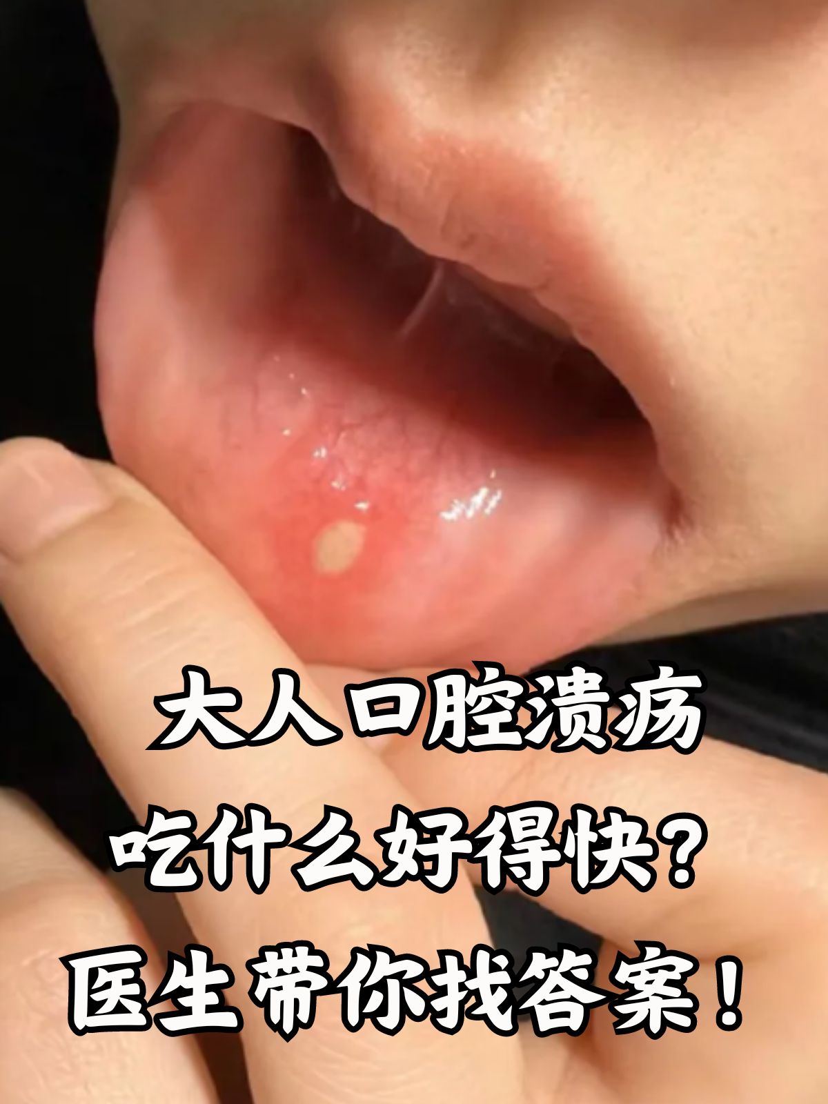 蜂蜜吃多了会口腔溃疡吗(蜂蜜吃多了会口腔溃疡吗为什么) 蜂蜜吃多了会口腔溃疡吗(蜂蜜吃多了会口腔溃疡吗为什么)