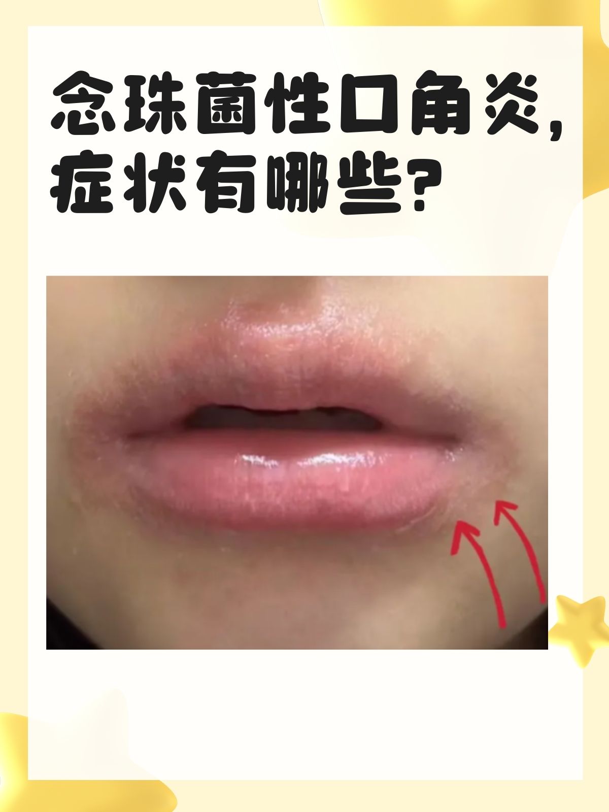 念珠菌性口角炎症状有哪些