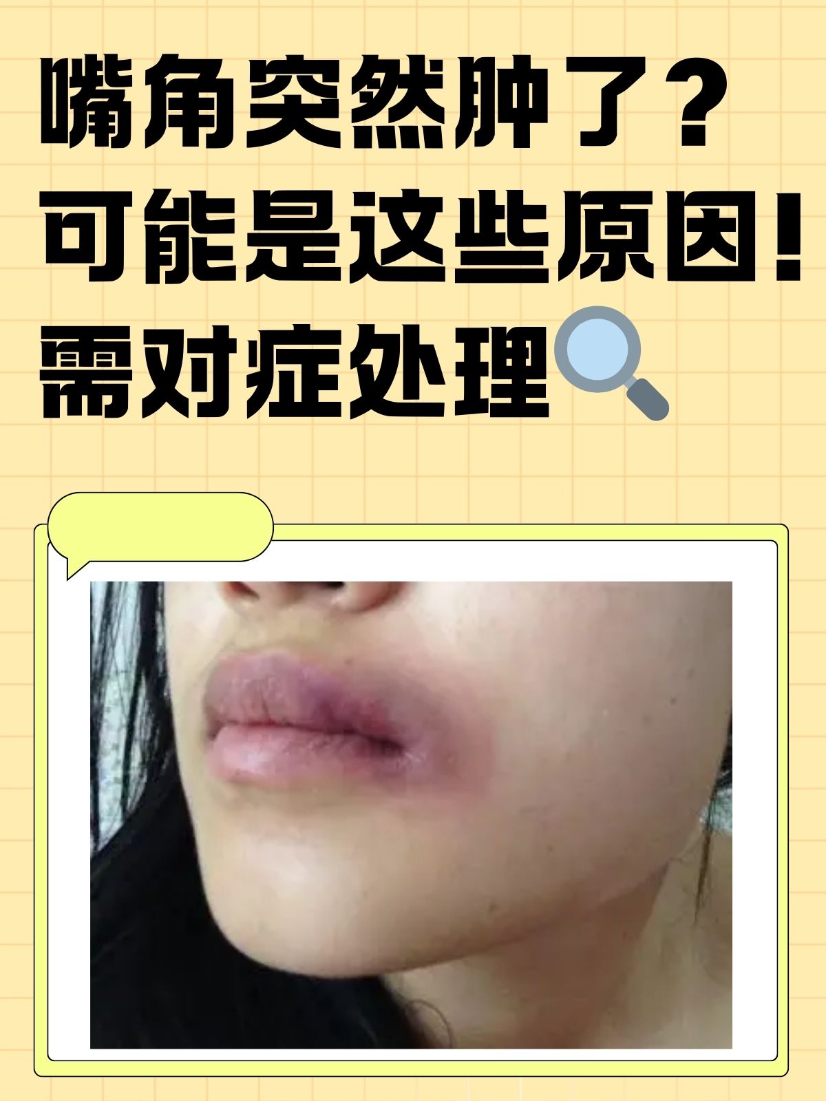 可能是这些原因!需对症处理 早上醒来,突然发现嘴角肿得像个香肠嘴?
