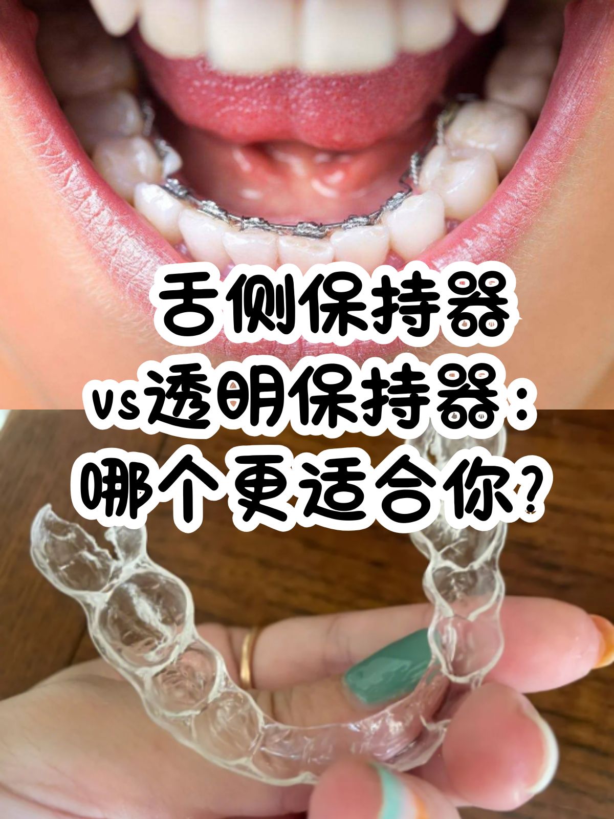 舌侧固定保持器图片