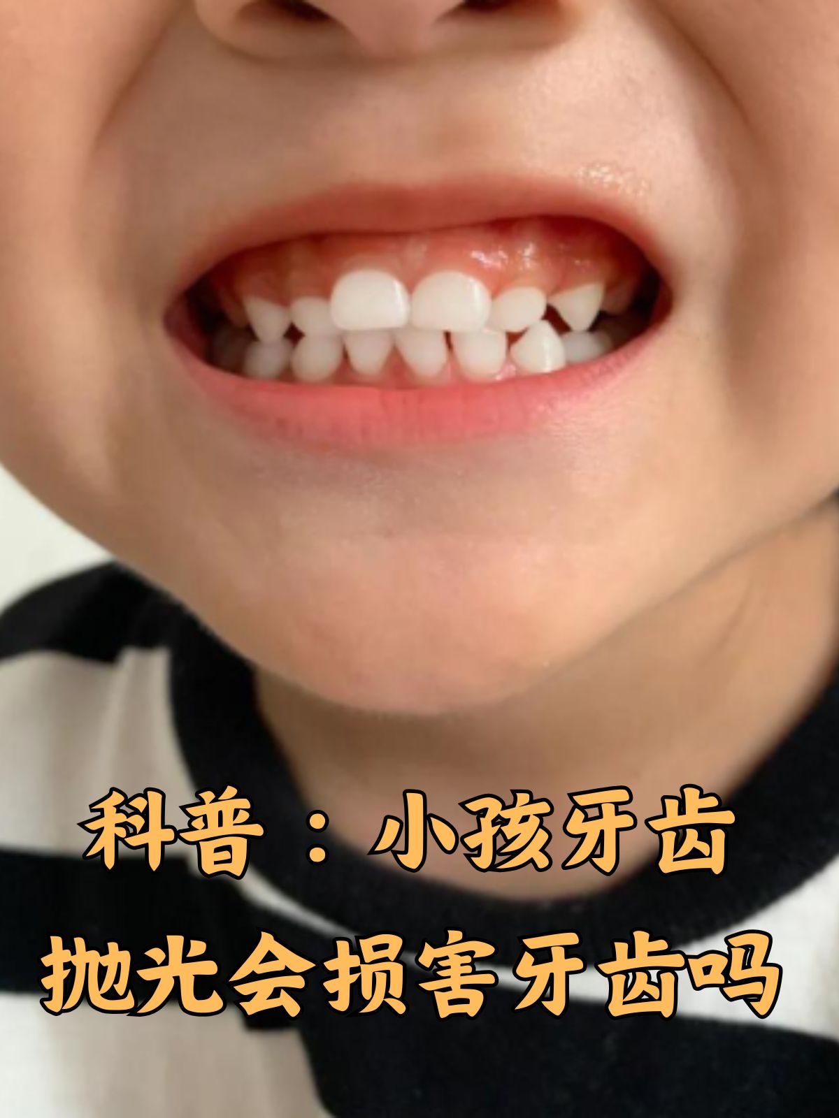 科普:小孩牙齿抛光会损害牙齿吗 在孩子成长的过程中,牙齿健康始终是