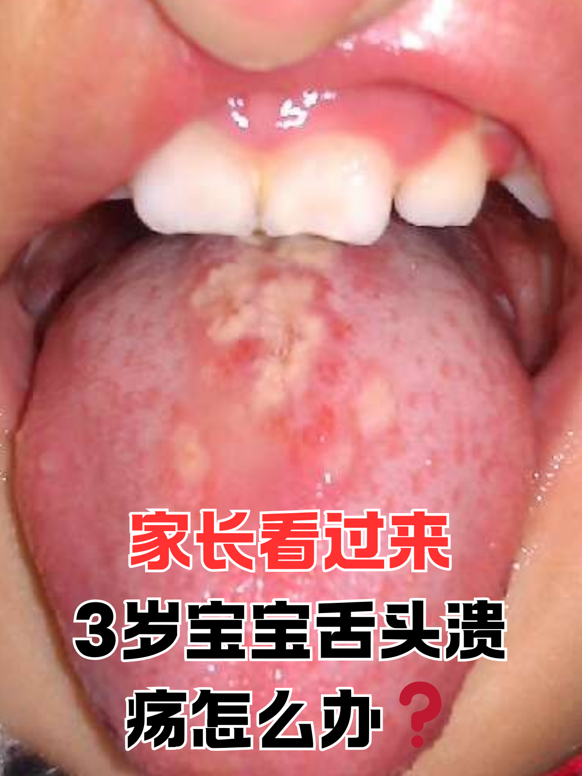 家长看过来,3岁宝宝舌头溃疡怎么办 舌头溃疡对于宝宝们来说是比较