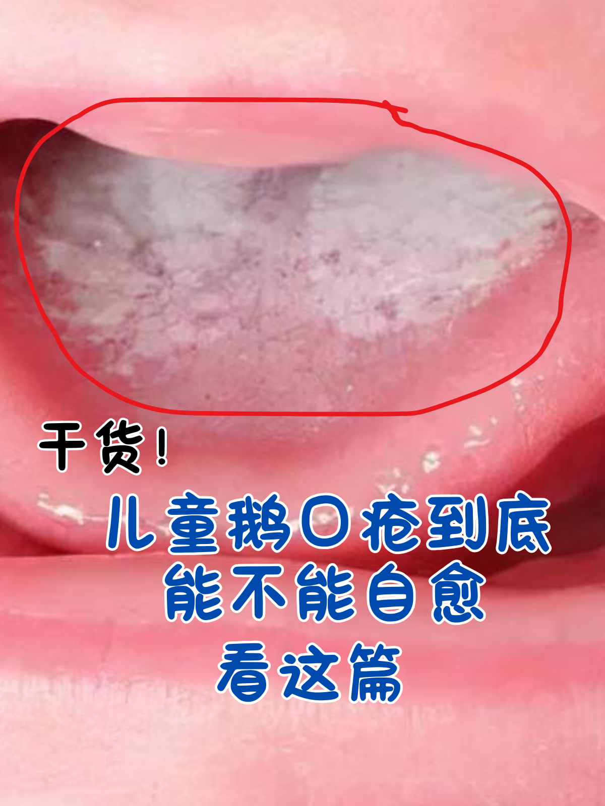 儿童鹅口疮到底能不能自愈,看这篇 鹅口疮是由白色念珠菌感染引起的