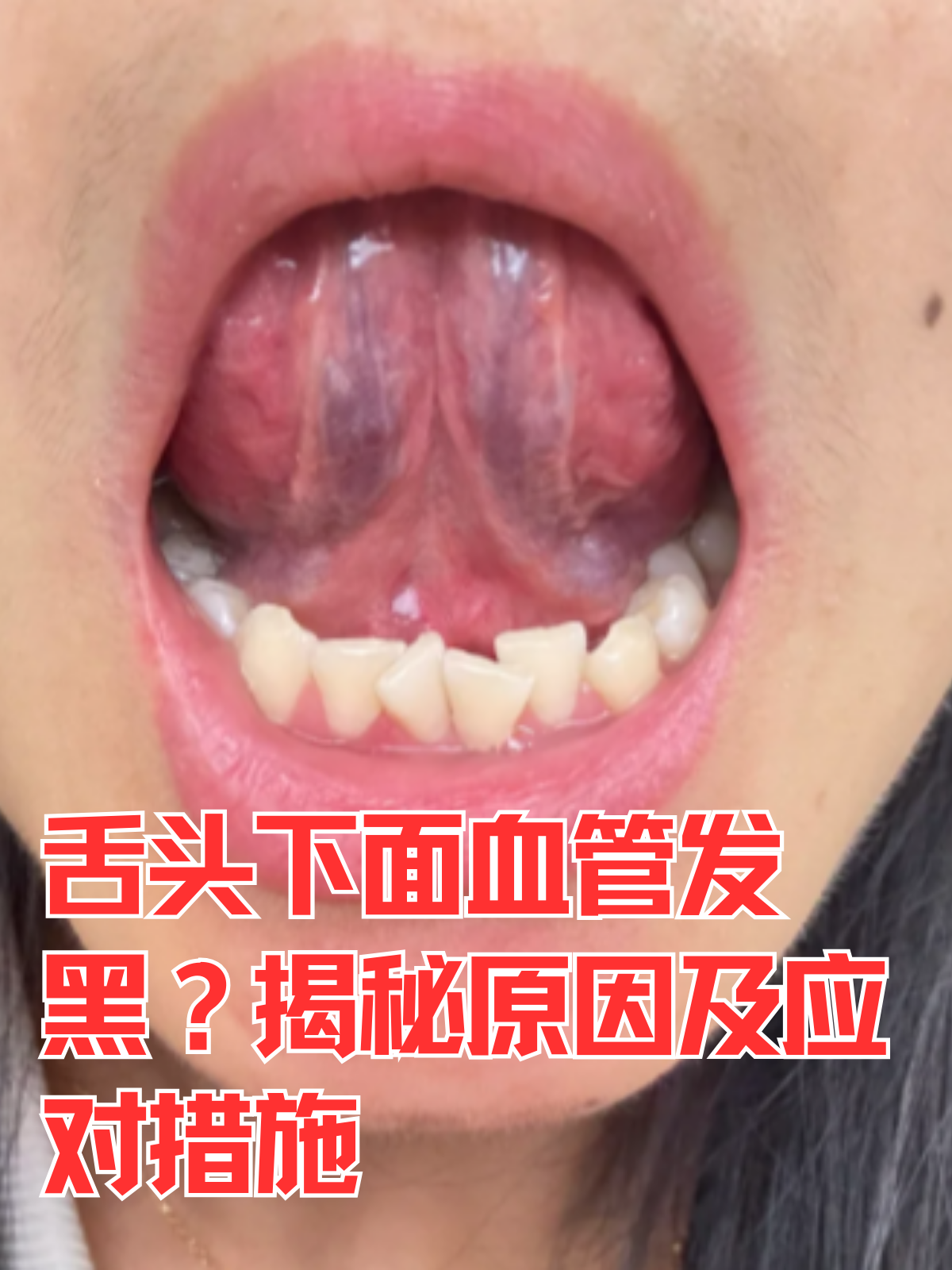 舌头下面血管发黑?揭秘原因及应对.@杨韵医生的动态