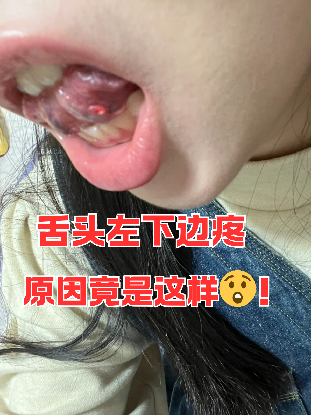 舌头疼怎么回事舌头下面长溃疡是什么原因造成的舌头底下溃疡图片舌下