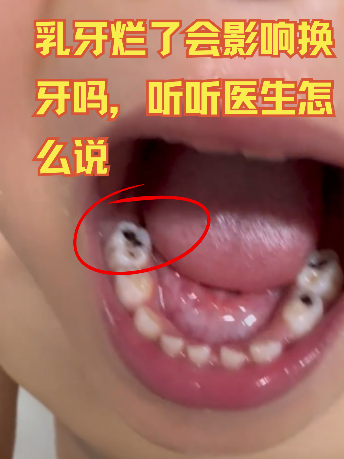 牙齿为什么会烂