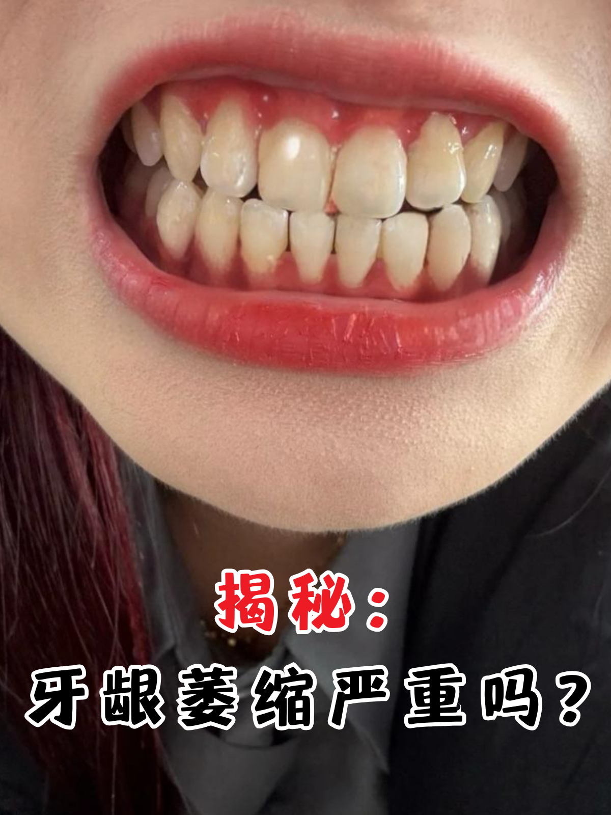 揭秘:牙龈萎缩严重吗?
