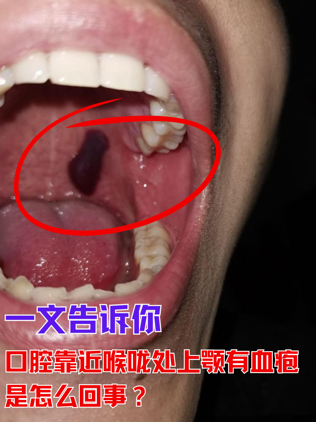 充血图片口腔癌黑血泡的图片口腔上颚起血泡的原因口腔内壁突然起黑
