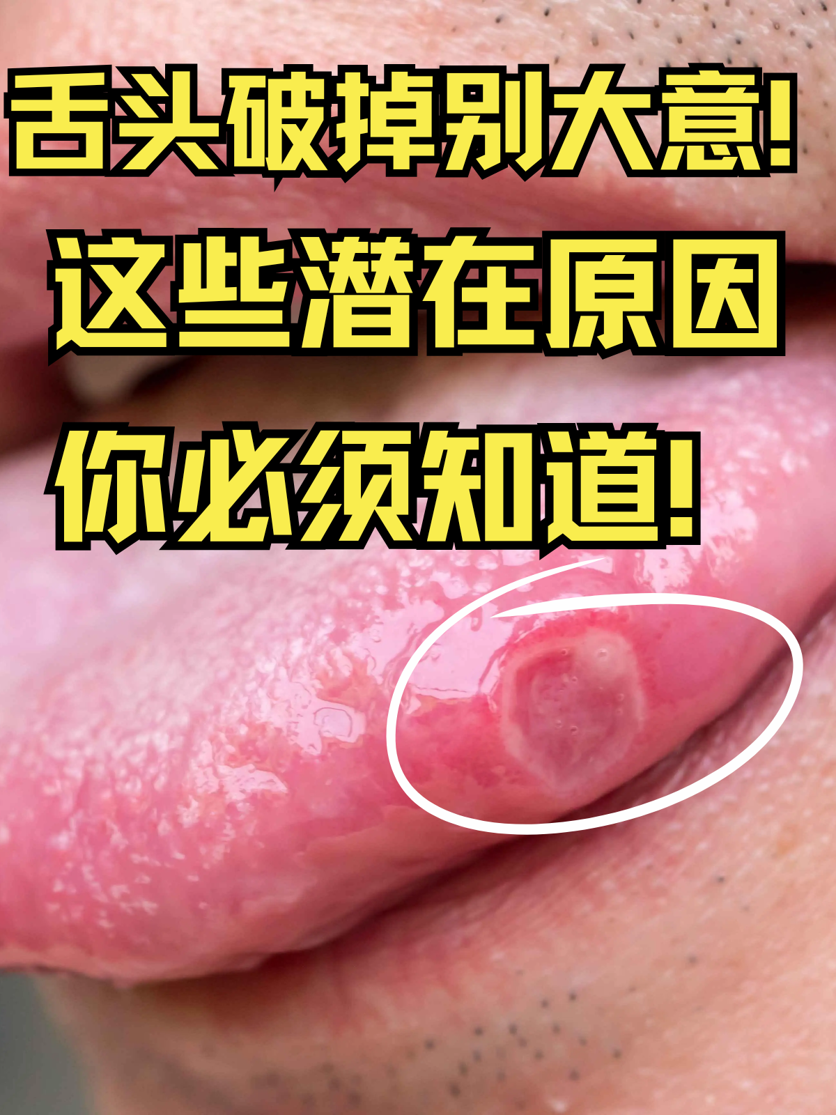 舌头破掉别大意!这些潜在原因你必.@杨韵医生的动态