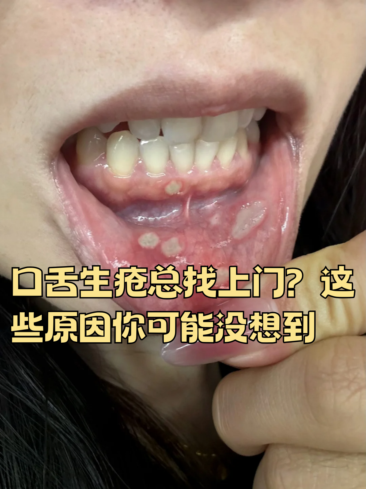 这些原因你可能没想到 口舌生疮,这一常见的口腔黏膜疾病,常常让人