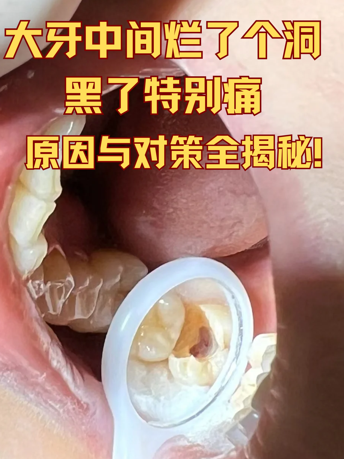大牙中间烂了个洞黑了特别痛,原因与对策全揭秘!