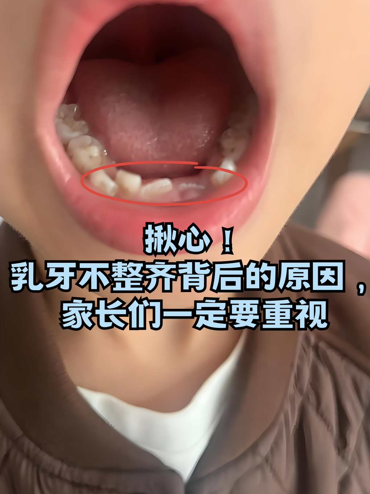 不少家长在给孩子刷牙,拍照时,会发现乳牙排列得歪歪扭扭,瞬间担忧这