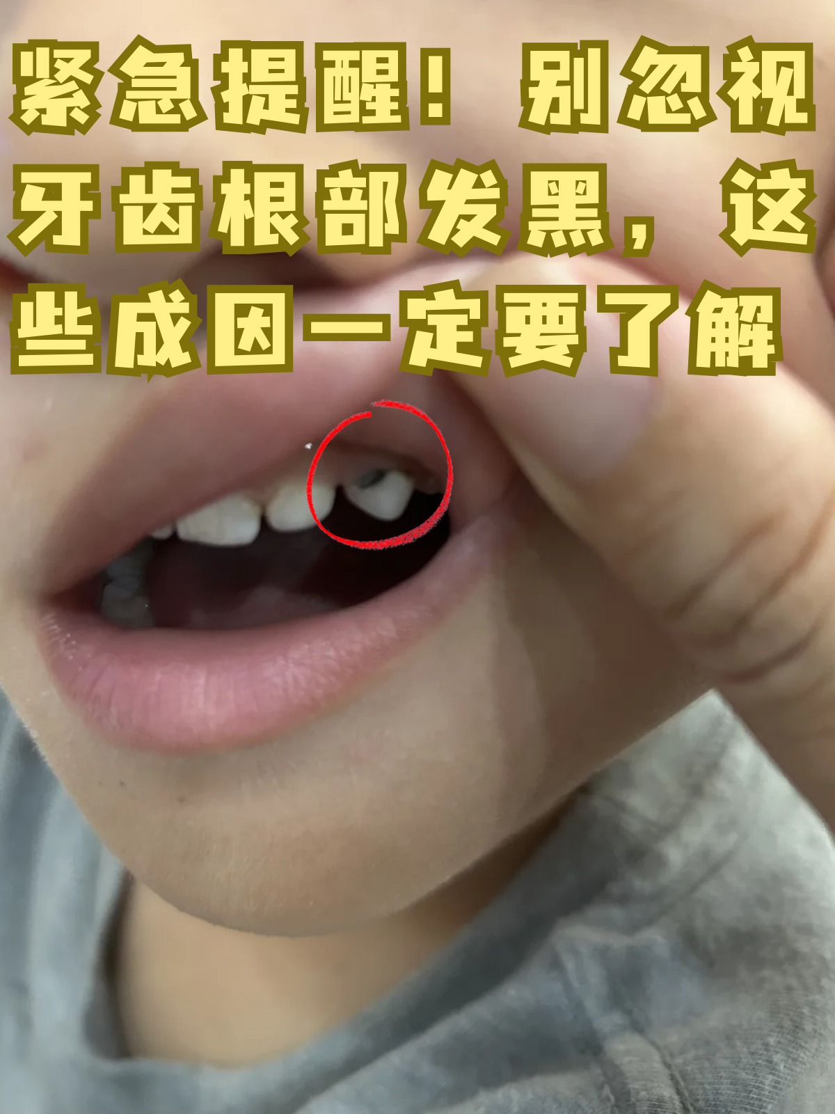 牙齿根部本应呈现白色或乳白色,一旦变黑,可能不仅影响美观,更暗示着