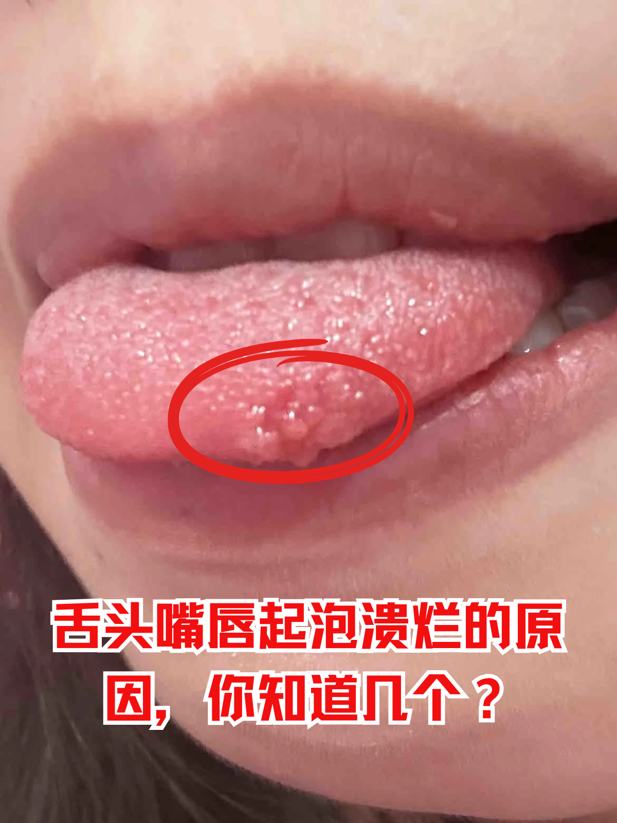 舌头和嘴唇出现起泡,溃烂等症状,往往让人坐立难安