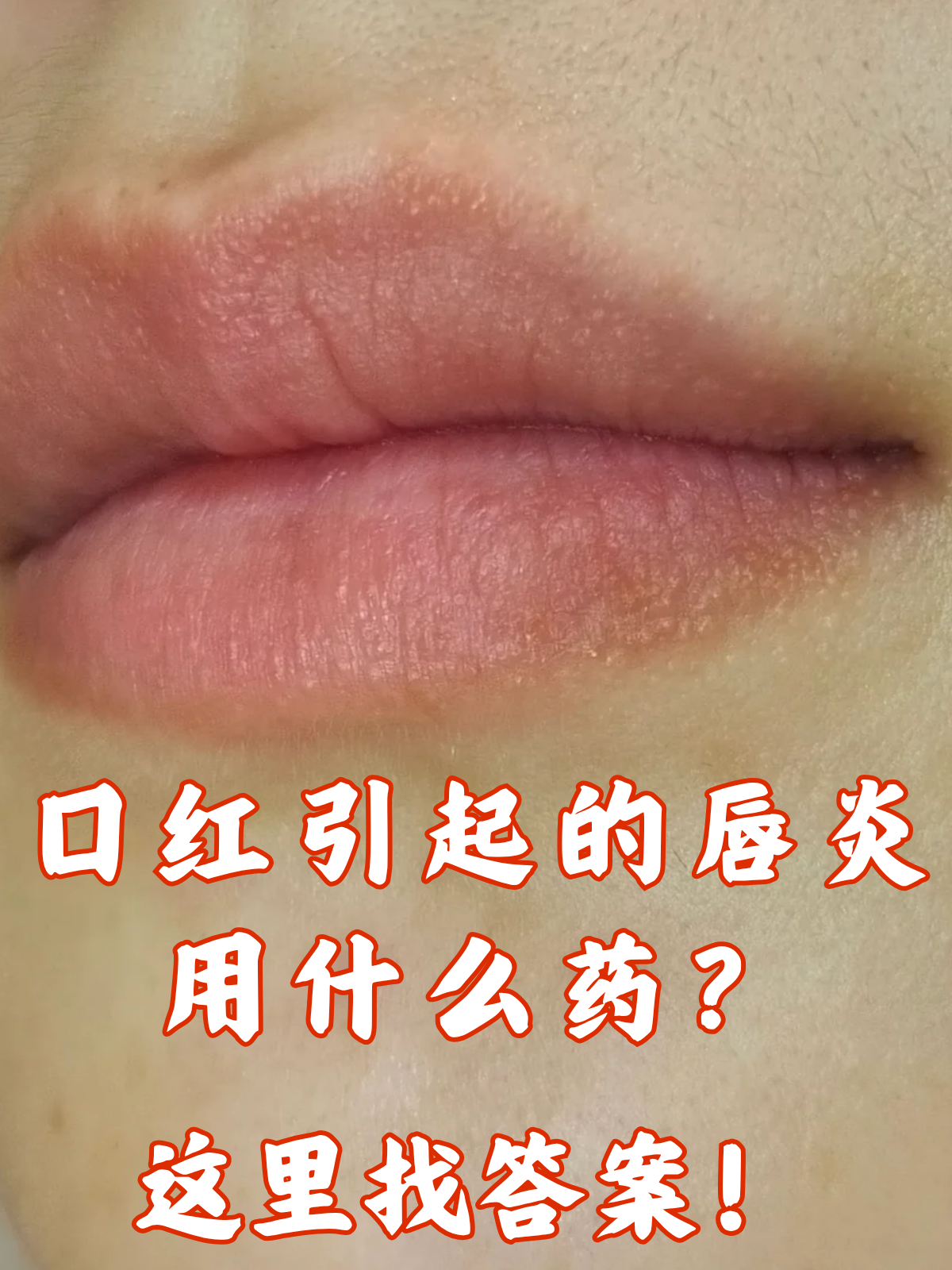 过敏性唇周边炎症怎么办口周唇炎图片唇炎的图片及口红引起的唇炎用