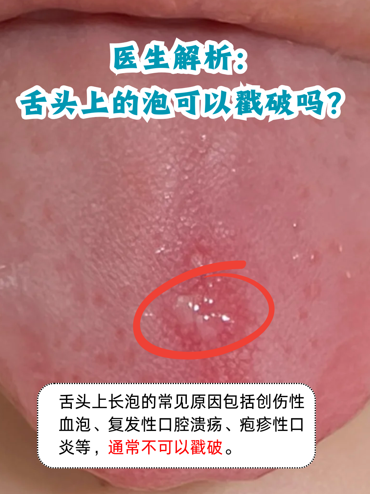 为什么舌头经常长溃疡呢