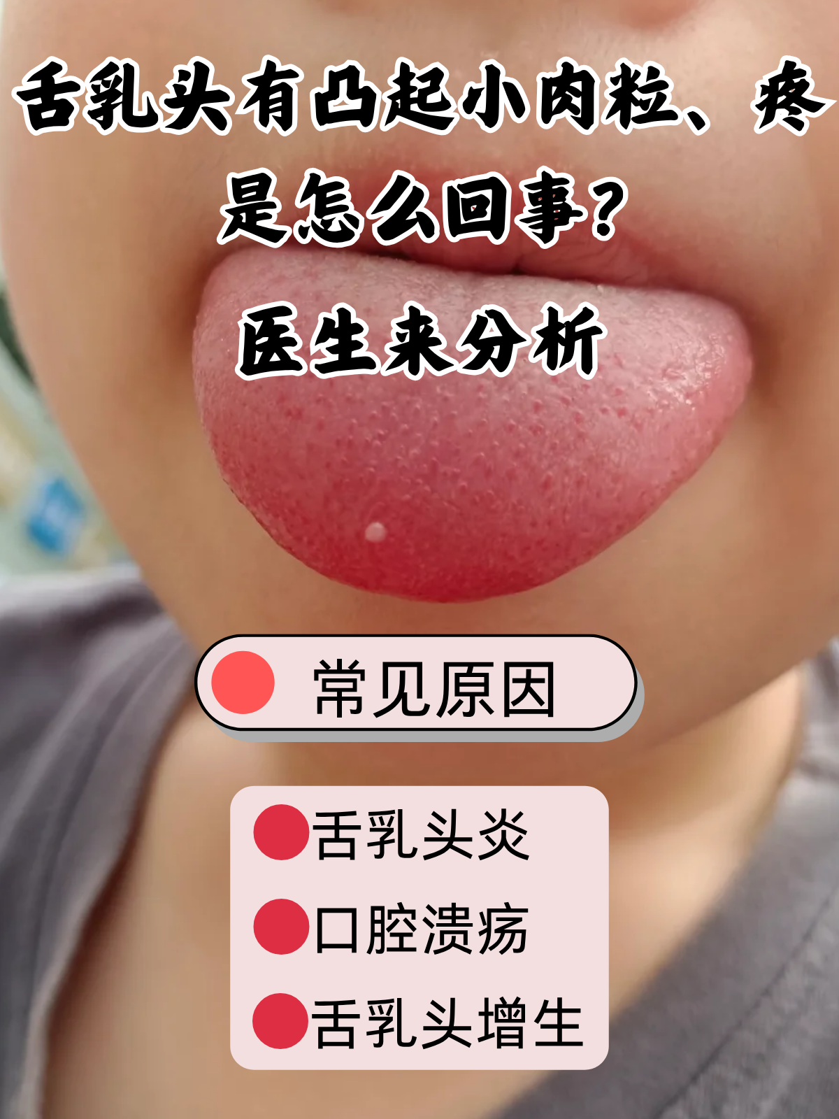 舌乳头有凸起小肉粒,疼是怎么回事?